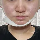 糸リフト / 脂肪吸引（顔） / ボトックス（エラ・小顔） HAAB×DREAM BEAUTY CLINIC 東京本院 DAY 1 サムネイル用
