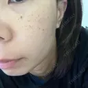 ルメッカ Belle Via Skin Clinic DAY 1 サムネイル用