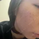 ルメッカ Belle Via Skin Clinic DAY 2 サムネイル用