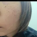 ルメッカ Belle Via Skin Clinic DAY 3 サムネイル用