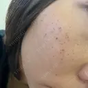 ルメッカ Belle Via Skin Clinic DAY 3 サムネイル用