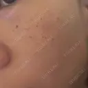 ルメッカ Belle Via Skin Clinic DAY 4 サムネイル用