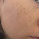 ルメッカ Belle Via Skin Clinic DAY 4 サムネイル用