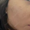 ルメッカ Belle Via Skin Clinic DAY 5 サムネイル用