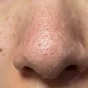 アグネス / その他（鼻） フェアクリニック川口 DAY 8 サムネイル用