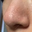 アグネス / その他（鼻） フェアクリニック川口 DAY 8 サムネイル用