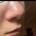 アグネス / その他（鼻） フェアクリニック川口 DAY 9 サムネイル用