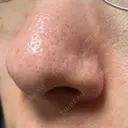 アグネス / その他（鼻） フェアクリニック川口 DAY 9 サムネイル用