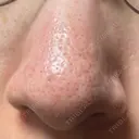 アグネス / その他（鼻） フェアクリニック川口 DAY 9 サムネイル用