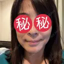 ハイフ（顔） ASTRA BEAUTY CLINIC AFTER サムネイル用