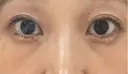 その他（目元） / クマ治療 / 下まぶたたるみ取り / 下まぶたの脂肪取り お茶の水美容形成クリニック DAY 26 サムネイル用