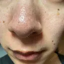 アグネス / その他（鼻） フェアクリニック川口 AFTER サムネイル用