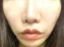 ヒアルロン酸注入（唇） / ボトックス（口角） おおたかの森ビューティークリニック DAY 0 サムネイル用