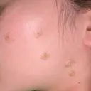 ほくろ・いぼ除去レーザー（肌） Jスキンクリニック 【J-SKIN clinic】 AFTER サムネイル用