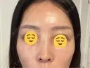 水光注射（ハリ・美肌） オラクル美容皮膚科 東京新宿院 AFTER サムネイル用