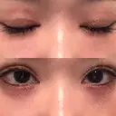 自然癒着法 シンデレラ＆ダヴィンチクリニック AFTER サムネイル用