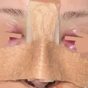 鼻尖形成（切開） / 軟骨移植 / 骨切幅寄せ / プロテーゼ除去 9BeautyClinic DAY 1 サムネイル用