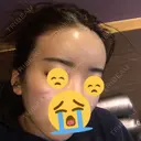 脂肪吸引（顔） / 額を丸く / 脂肪吸引（脚） / こめかみ形成 / 輪郭修正 / 脂肪注入（額） / 脂肪注入（輪郭） フレッシュ整形外科 DAY 63 サムネイル用