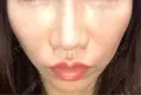 ヒアルロン酸注入（唇） / ボトックス（口角） おおたかの森ビューティークリニック DAY 3 サムネイル用
