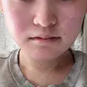 糸リフト / 脂肪吸引（顔） / ボトックス（エラ・小顔） HAAB×DREAM BEAUTY CLINIC 東京本院 DAY 14 サムネイル用