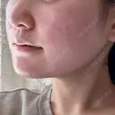 糸リフト / 脂肪吸引（顔） / ボトックス（エラ・小顔） HAAB×DREAM BEAUTY CLINIC 東京本院 DAY 14 サムネイル用