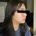 脂肪吸引（顔） / ジョールファット除去 / 脂肪注入（輪郭） 湘南美容クリニック 吉祥寺院 DAY 6 サムネイル用