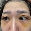 二重埋没 / クマ治療 湘南美容クリニック 西葛西院 AFTER サムネイル用