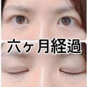 その他（目元） / 自然癒着法 LUHO（ルホ）美容外科 AFTER サムネイル用