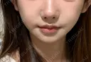 ボトックス（エラ・小顔） L‘amour clinic Tokyo【ラムールクリニック東京】 DAY 7 サムネイル用