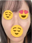 その他（輪郭） ARTE BEAUTY CLINIC DAY 5 サムネイル用