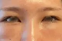 クマ治療 湘南美容クリニック 表参道院 DAY 6 サムネイル用