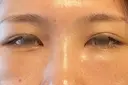 クマ治療 湘南美容クリニック 表参道院 DAY 7 サムネイル用