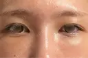 クマ治療 湘南美容クリニック 表参道院 DAY 14 サムネイル用