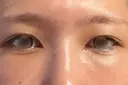 クマ治療 湘南美容クリニック 表参道院 DAY 21 サムネイル用