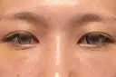 クマ治療 湘南美容クリニック 表参道院 DAY 28 サムネイル用