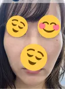その他（輪郭） ARTE BEAUTY CLINIC DAY 6 サムネイル用