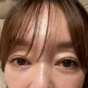二重埋没 / ほくろ・いぼ切除（肌） / 自然癒着法 / ボトックス（眉間） / ボトックス（目尻） / ボトックス（人中） CLINIC W DAY 18 サムネイル用