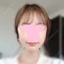 骨削り（頬） FROM B整形外科 (旧バウム整形外科) DAY 16 サムネイル用