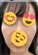 その他（輪郭） ARTE BEAUTY CLINIC DAY 7 サムネイル用