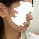 その他（肌） LUNA BEAUTY CLINIC 池袋駅前院 DAY 36 サムネイル用