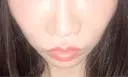 ヒアルロン酸注入（唇） / ボトックス（口角） おおたかの森ビューティークリニック AFTER サムネイル用
