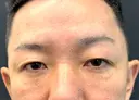 下まぶたたるみ取り / 下まぶたの脂肪取り / 脂肪注入（目の下） 湘南美容クリニック 千葉センシティ院 AFTER サムネイル用