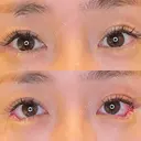 目尻切開 / タレ目形成・グラマラスライン（埋没） LOUIS CLINIC 二子玉川院【ルイクリニック】 DAY 0 サムネイル用