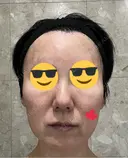 シミ取りレーザー / ピコスポット Olino美容外科・美容皮膚科 AFTER サムネイル用