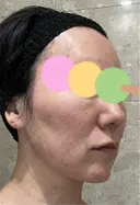 シミ取りレーザー / ピコスポット Olino美容外科・美容皮膚科 DAY 99 サムネイル用