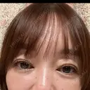 二重埋没 / ほくろ・いぼ切除（肌） / 自然癒着法 / ボトックス（眉間） / ボトックス（目尻） / ボトックス（人中） CLINIC W DAY 21 サムネイル用