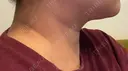 ハイフ（顔） HINATA クリニック AFTER サムネイル用