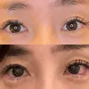 目尻切開 / タレ目形成・グラマラスライン（埋没） LOUIS CLINIC 二子玉川院【ルイクリニック】 DAY 1 サムネイル用