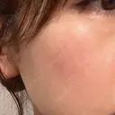 ピコレーザートーニング（美白・肝斑） / ピコフラクショナルレーザー（毛穴・ニキビ跡） / ピコスポット 大美会クリニック 天王寺院 DAY 10 サムネイル用