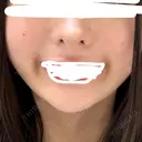 ヒアルロン酸注入（唇） / ヒアルロン酸注入（鼻翼基部） 銀座美容外科クリニック 新宿院 DAY 1 サムネイル用